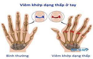 Dấu hiệu viêm khớp dạng thấp ở tay