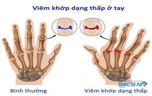 Dấu hiệu viêm khớp dạng thấp ở tay