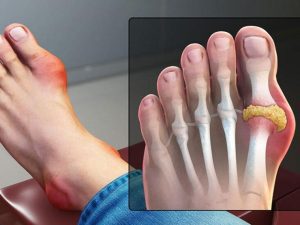 Đối với người bệnh gout sẽ ảnh hưởng đến sức khỏe thận, làm giảm đào thải acid uric.